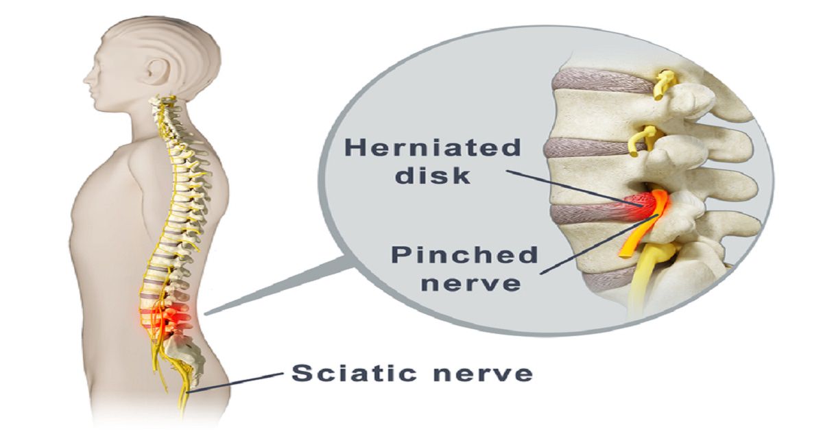 how-to-relieve-a-trapped-nerve-in-your-shoulder-patient-s-lounge